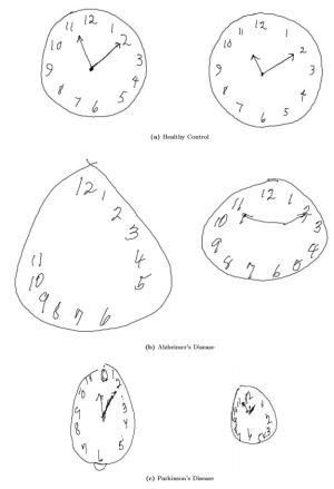 Na imagem são mostradas as diferenças nos desenhos de acordo com a doença. A primeira fila mostra dois relógios feitos por pacientes sãos. Na fila central, o paciente sofre de Alzheimer e na fila inferior, Parkinson.