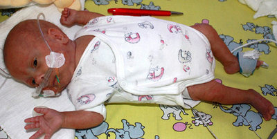 El Desafio Del Bebe Que Peso 275 Gramos Al Nacer Salud El Pais